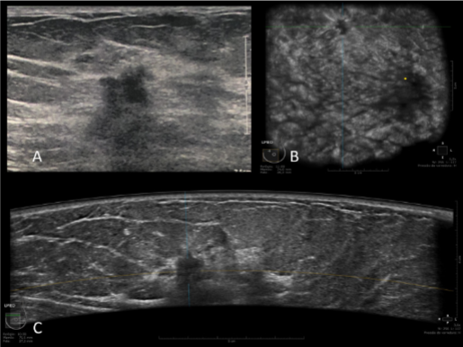 Automated Breast Ultrasound (ABUS): uma tecnologia inovadora e diferenciado na avaliação de mamas densas no rastreamento de câncer.