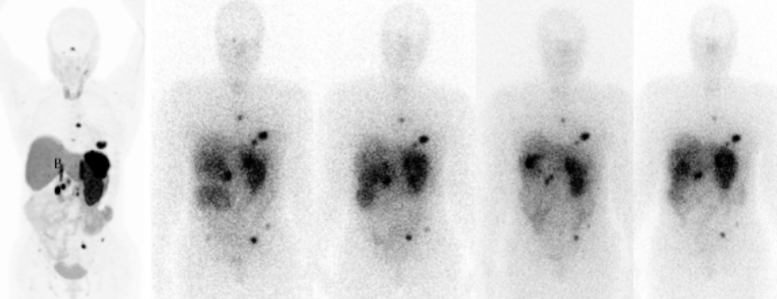 Teranóstica Lu-DOTATATE: Avaliação Renal Dosimetria usando Dosimetry Toolkit para tratamento de um tumor neuroendócrino metastático de um paciente com um único rim