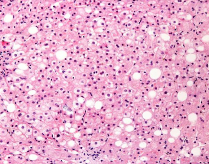 Ultrasound-Guided Attenuation Parameter: Uma Importante Ferramenta na Avaliação da Síndrome Metabólica