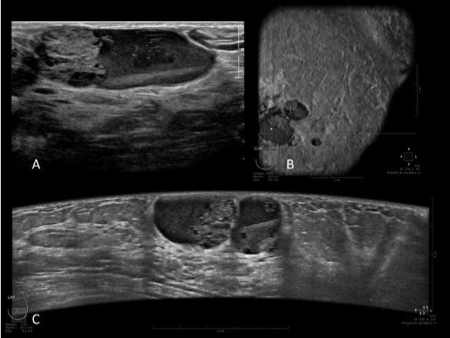 Automated Breast Ultrasound (ABUS): uma tecnologia inovadora e diferenciado na avaliação de mamas densas no rastreamento de câncer.
