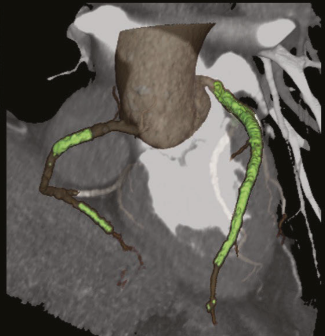 Advanced High-Resolution CT Approaches for Coronary Stent and Calcified Plaque Assessment