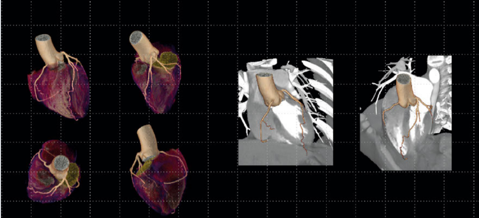 Advanced Motion Correction in Challenging Coronary CT Angiography: Clinical Impact of SnapShot Freeze 2