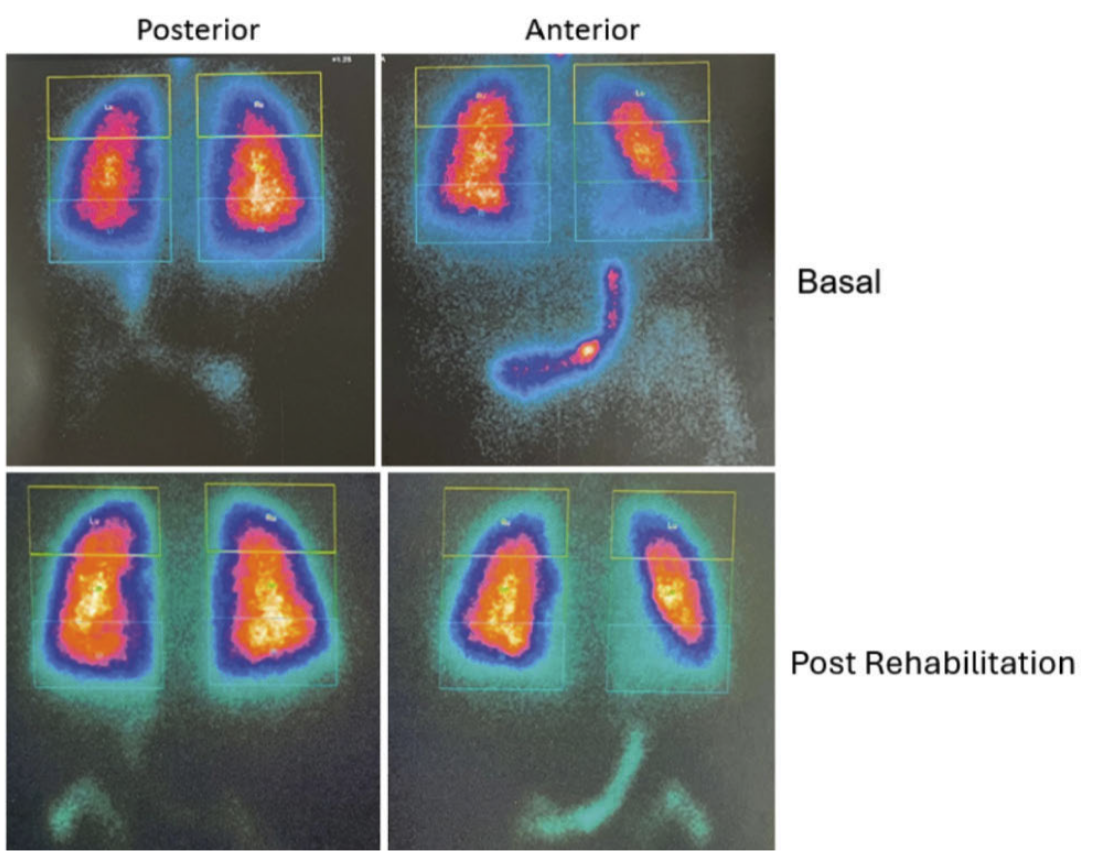Patients with post-COVID-19 syndrome often present with persistent and diff icult-to-characterize respiratory symptoms, such as dyspnea and fatigue, making diagnosis and clinical follow-up challenging. Pulmonary V/Q scintigraphy using GEʼs SPECT technology provides three-dimensional imaging and precise functional data, enabling the identifi cation of ventilation and perfusion abnormalities even in subtle cases. This approach offers patients a more accurate diagnosis and measurable clinical improvement, while supporting physicians in therapeutic decision-making based on objective evidence.“ Importance of V/Q Scintigraphy in the Diagnosis and Monitoring of Post-COVID-19 Syndrome Using Volumetrix MI