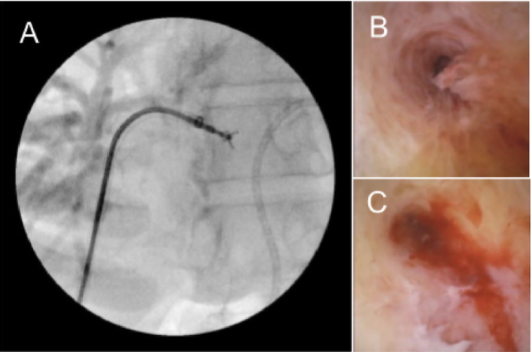 Advanced Hepatobiliary Intervention in  an Outpatient Setting: Expanding Access  to High-Complexity Care with OEC 3D
